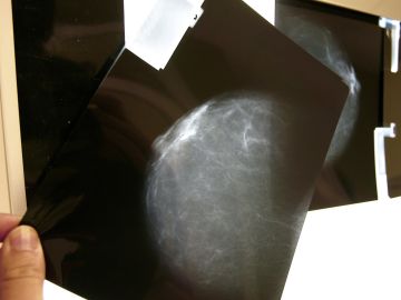 Fotografía de archivo de una prueba radiológica de mama. 