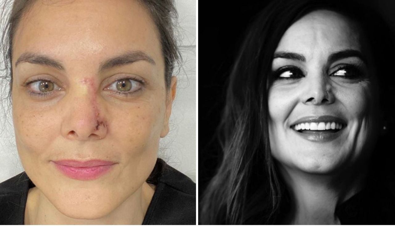 Las razones por las que Mónica Carrillo muestra en Twitter las secuelas del cáncer de piel Las razones por las que Mónica Carrillo muestra en Twitter las secuelas del cáncer de piel