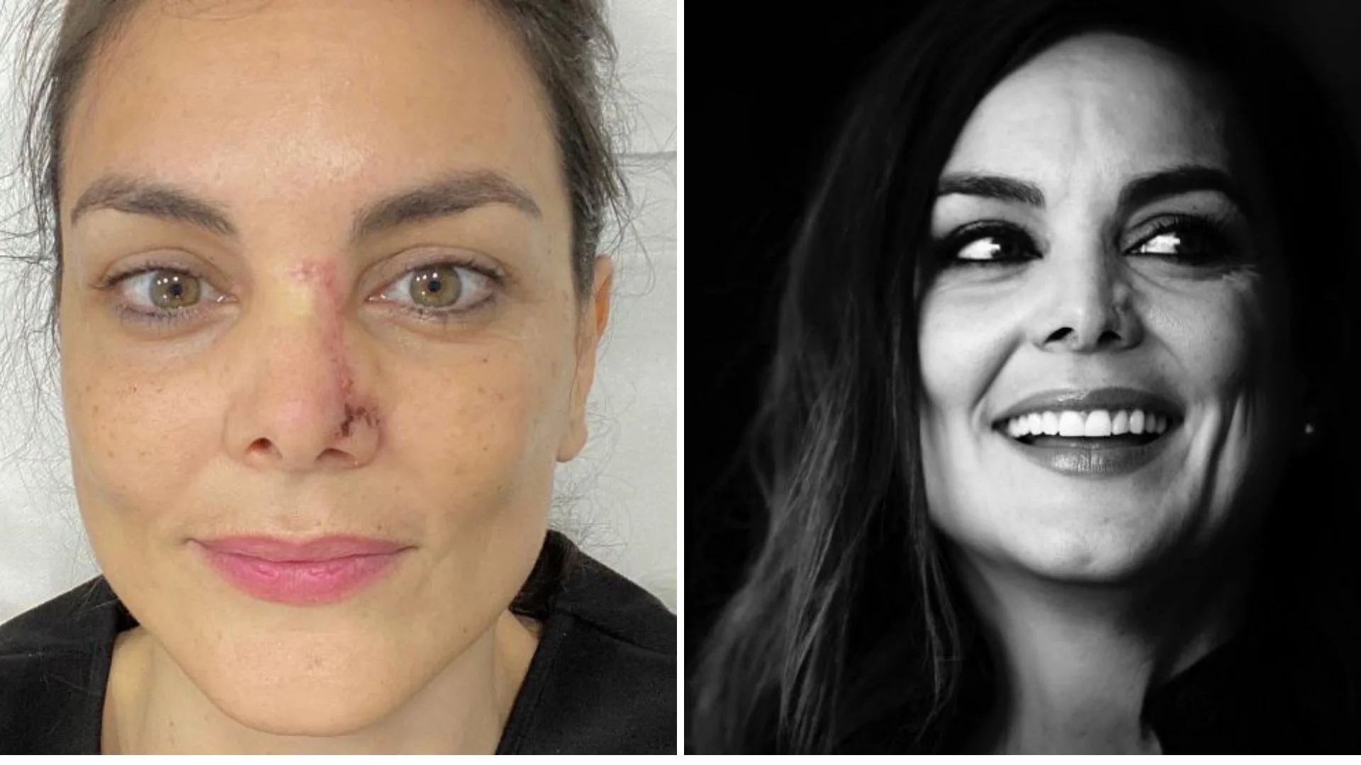 Las razones por las que Mónica Carrillo muestra en Twitter las secuelas del cáncer de piel Las razones por las que Mónica Carrillo muestra en Twitter las secuelas del cáncer de piel