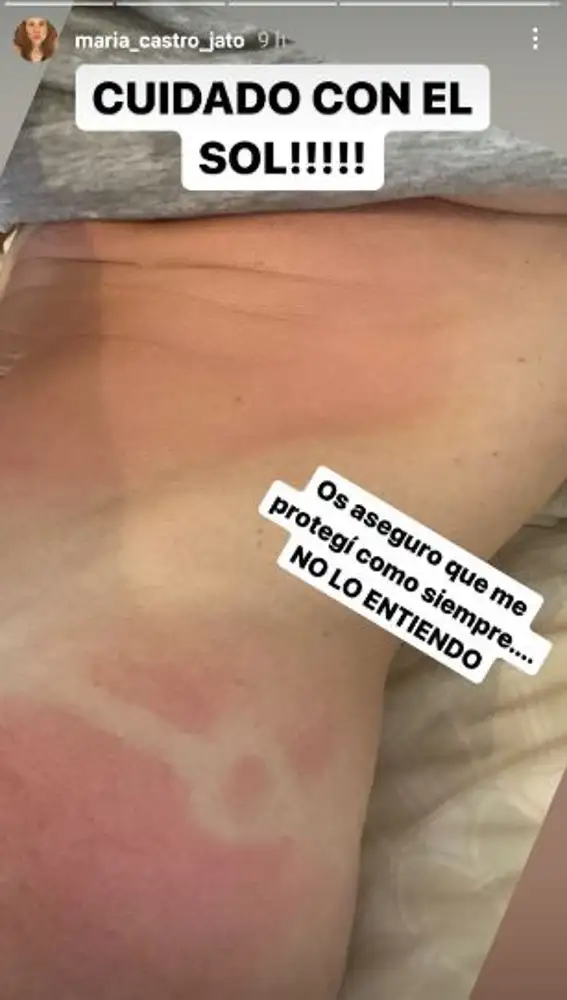 Las quemaduras de María Castro