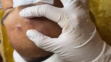 VÍDEO: Una dermatóloga revienta numerosos granos en la frente de un paciente
