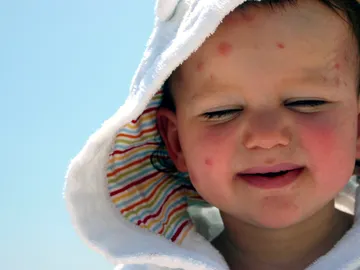 ¡Despídete de las picaduras! ¡Despídete de las picaduras!