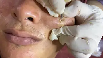 Un dermatólogo quita un gigantesco grano de la mejilla de un paciente