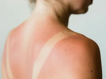 ¿Te has quemado con el sol? Estos productos te vendrán de maravilla ¿Te has quemado con el sol? Estos productos te vendrán de maravilla