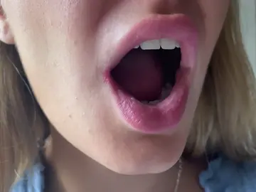 Remedios caseros para quitar las boqueras Remedios caseros para quitar las boqueras