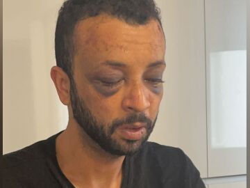 Costillas rotas y hematomas en la cabeza en una brutal agresión homófoba a un joven brasileño en A Coruña