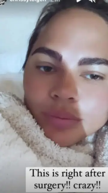 Chrissy Teigen muestra el resultado de su trasplante de cejas Chrissy Teigen muestra el resultado de su trasplante de cejas