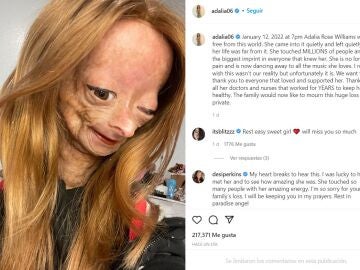 Muere Adalia Rose, la joven youtuber que padecía la enfermedad de 'Benjamin Button' e inspiró a millones