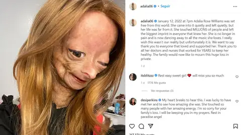 Muere Adalia Rose, la joven youtuber que padecía la enfermedad de 'Benjamin Button' e inspiró a millones Muere Adalia Rose, la joven youtuber que padecía la enfermedad de 'Benjamin Button' e inspiró a millones