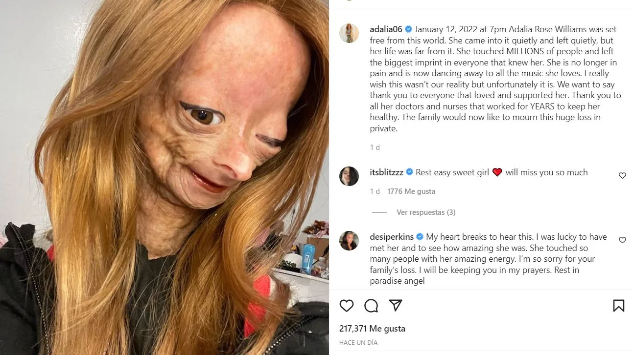 Muere Adalia Rose, la joven youtuber que padec&iacute;a la enfermedad de 'Benjamin Button' e inspir&oacute; a millones