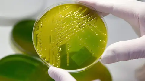 El virus de Epstein-Bar podría ser la principal causa de la esclerosis múltiple, según un macroestudio El virus de Epstein-Bar podría ser la principal causa de la esclerosis múltiple, según un macroestudio