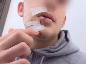 Un joven pide colaboración ciudadana para encontrar a los agresores que le golpearon con un vaso en la cara