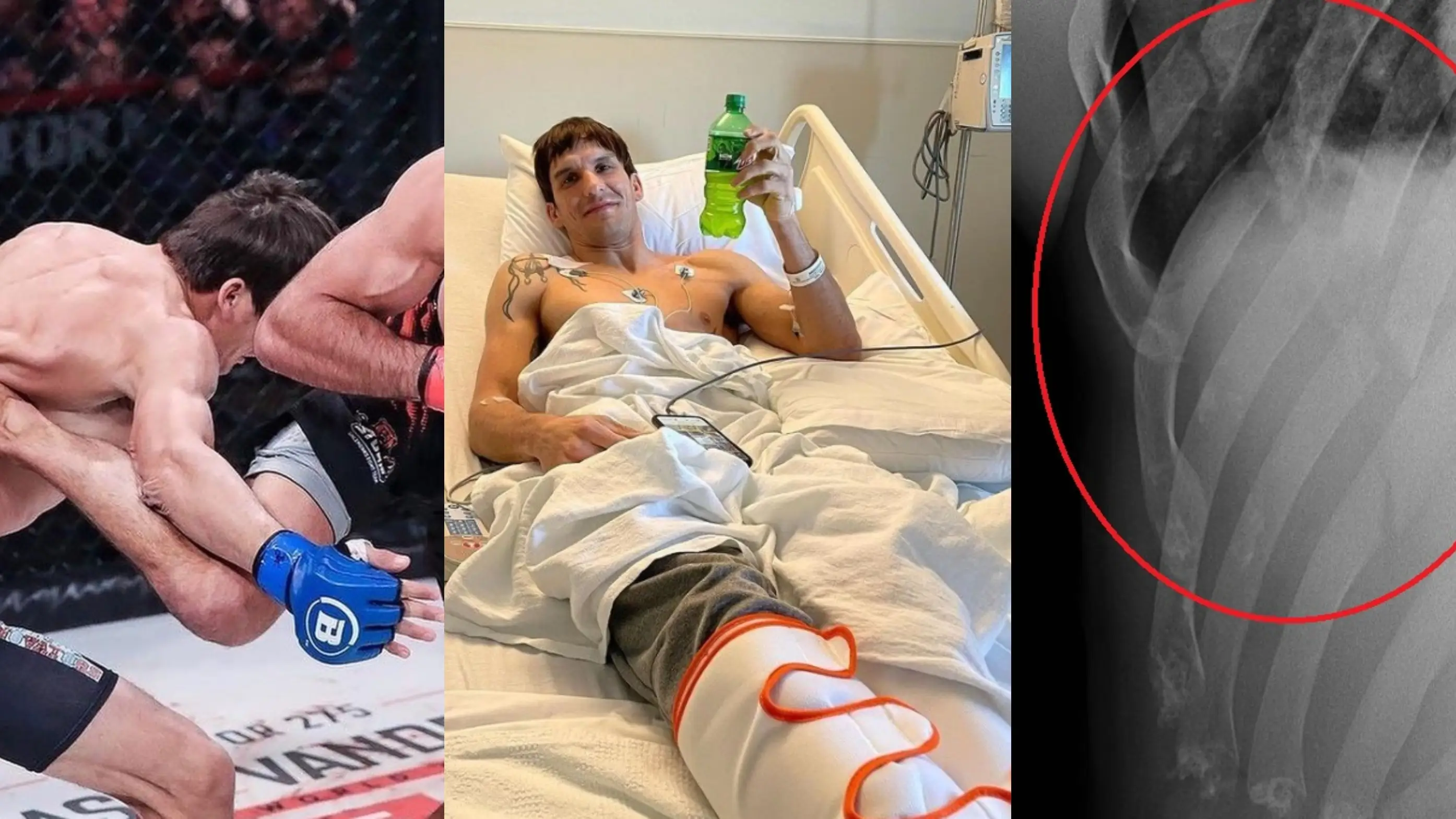 La patada más brutal en la historia de la MMA: cinco costillas rotas y perforación de pulmón La patada más brutal en la historia de la MMA: cinco costillas rotas y perforación de pulmón