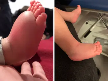 El antes y el después de Izan, un bebé de dos meses con linfedema El antes y el después de Izan, un bebé de dos meses con linfedema