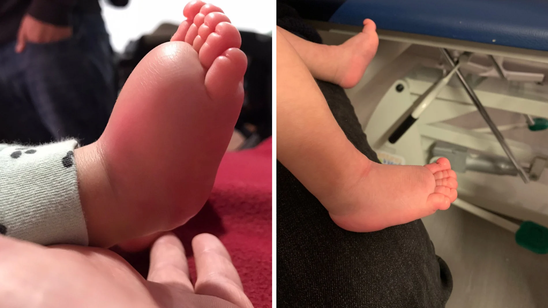 El antes y el después de Izan, un bebé de dos meses con linfedema