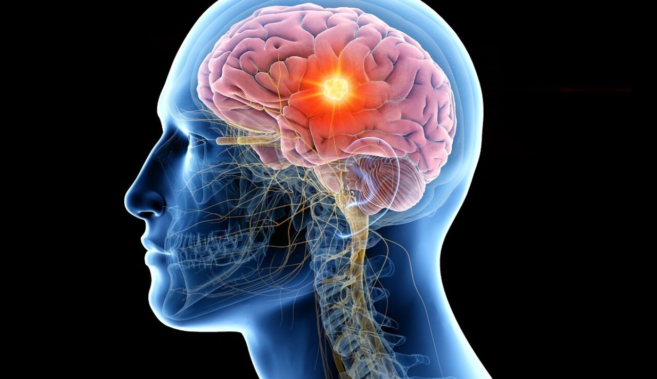 Ilustraci&oacute;n de un tumor cerebral