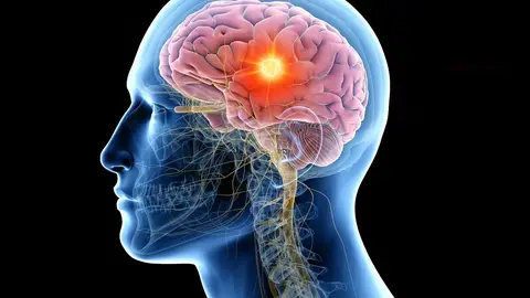 Ilustración de un tumor cerebral Ilustración de un tumor cerebral