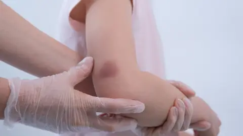 Niña con moratón en el brazo Niña con moratón en el brazo