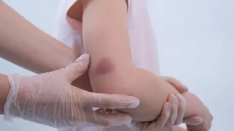 Niña con moratón en el brazo Niña con moratón en el brazo