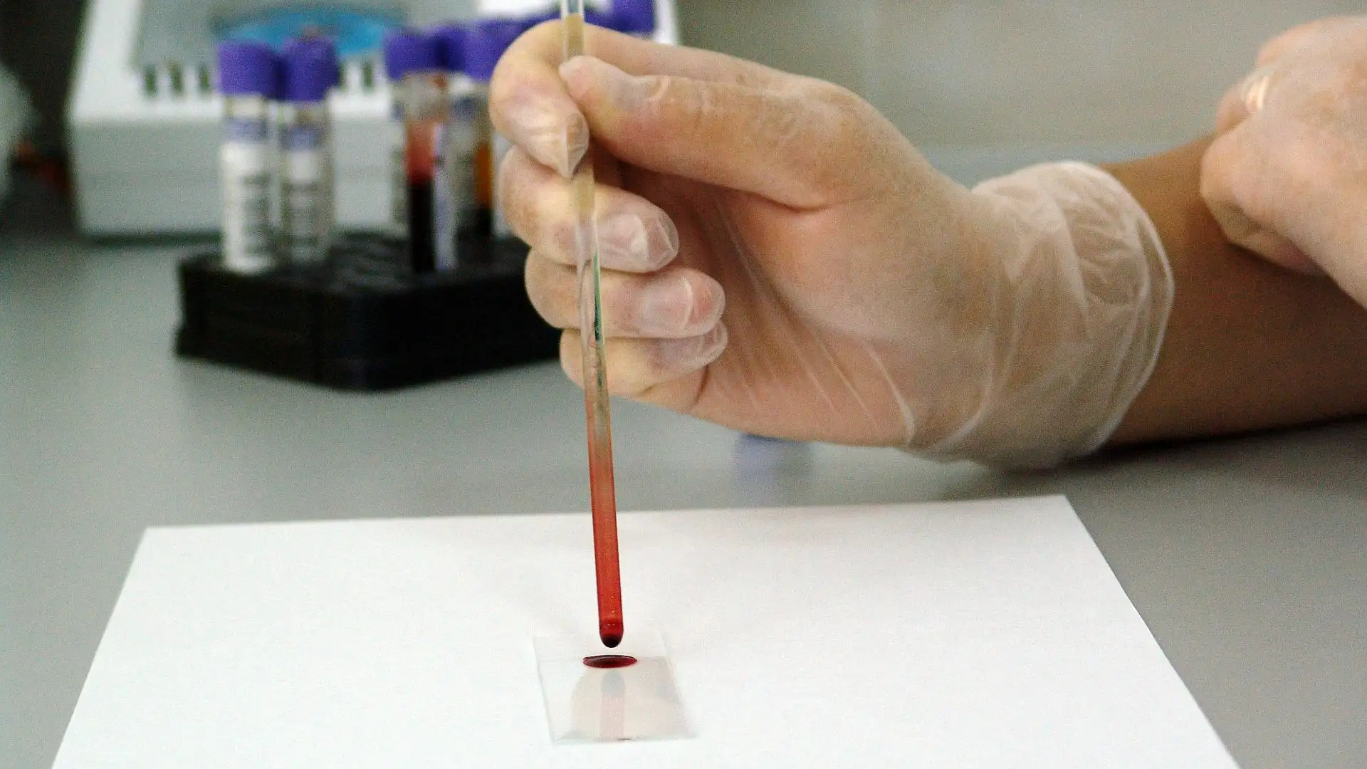 Un análisis de sangre Un análisis de sangre