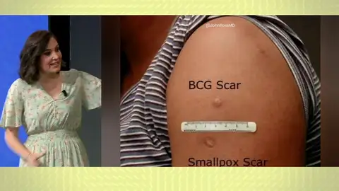 Lo que se sabe de la viruela del mono. Lo que se sabe de la viruela del mono.