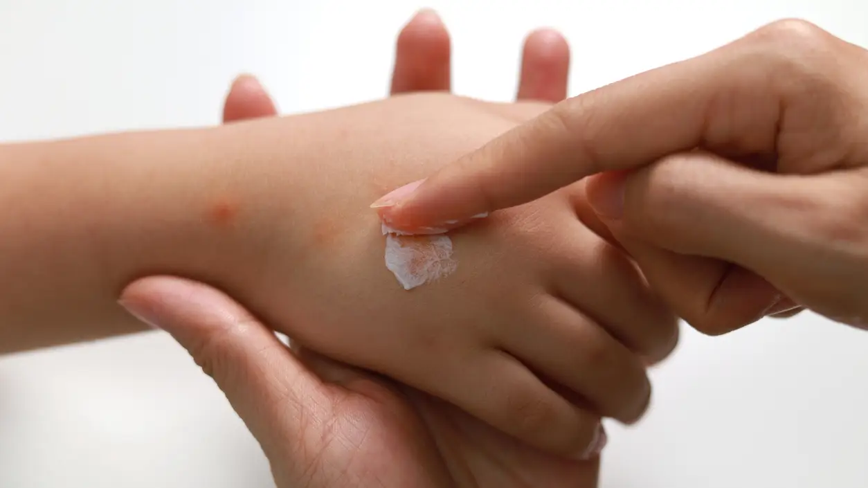&iquest;Tener la sangre dulce es la raz&oacute;n de que piquen m&aacute;s los mosquitos?