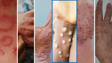 ¿Cómo diferenciar la viruela del mono de otras enfermedades de la piel? ¿Cómo diferenciar la viruela del mono de otras enfermedades de la piel?