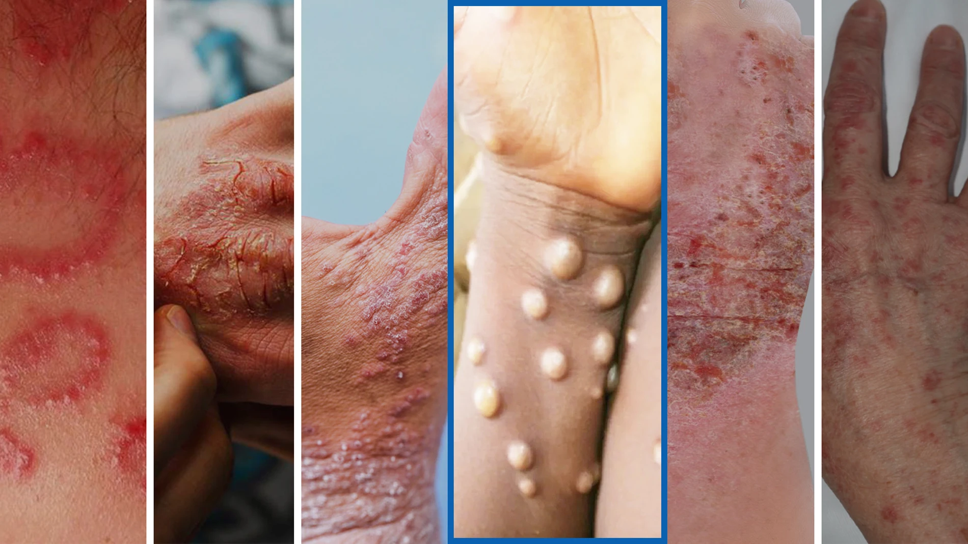 ¿Cómo diferenciar la viruela del mono de otras enfermedades de la piel?