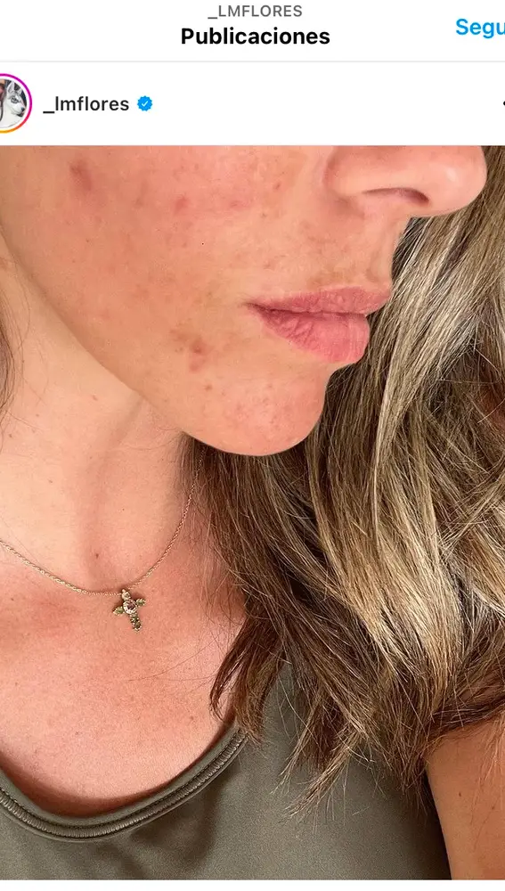 Laura Matamoros enseña su cara tras un brote de acné