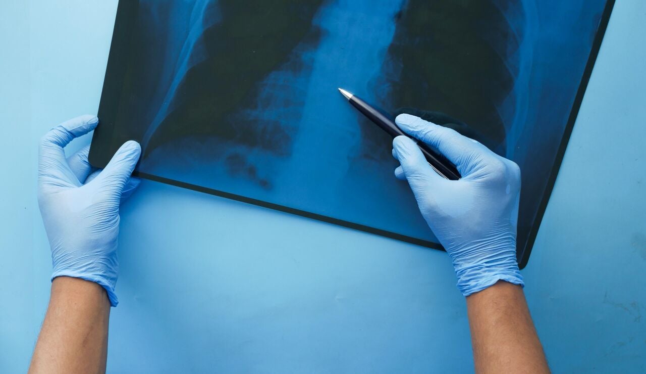 Radiografía pulmón