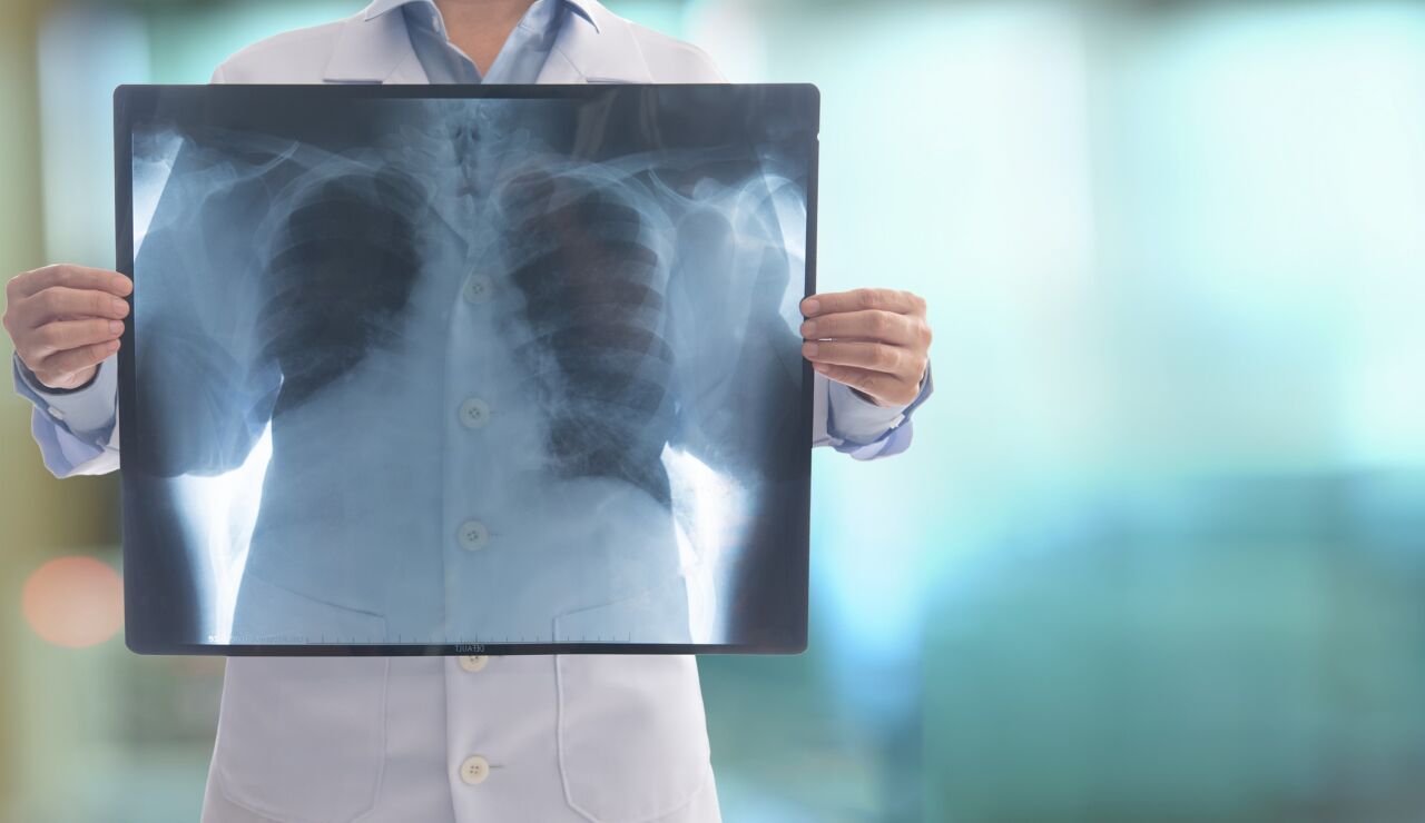 Radiografía de un pulmón