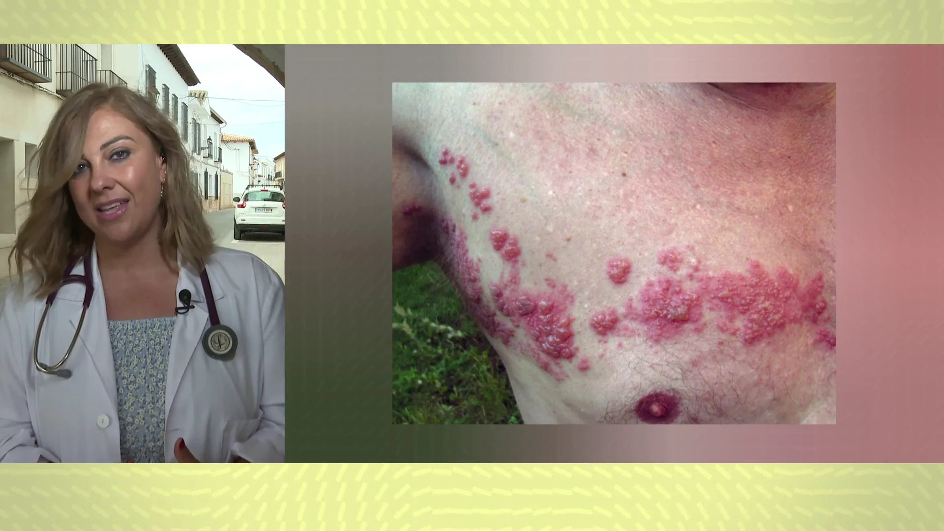 La doctora Ruth Martín de Diego habla sobre el herpes zóster La doctora Ruth Martín de Diego habla sobre el herpes zóster