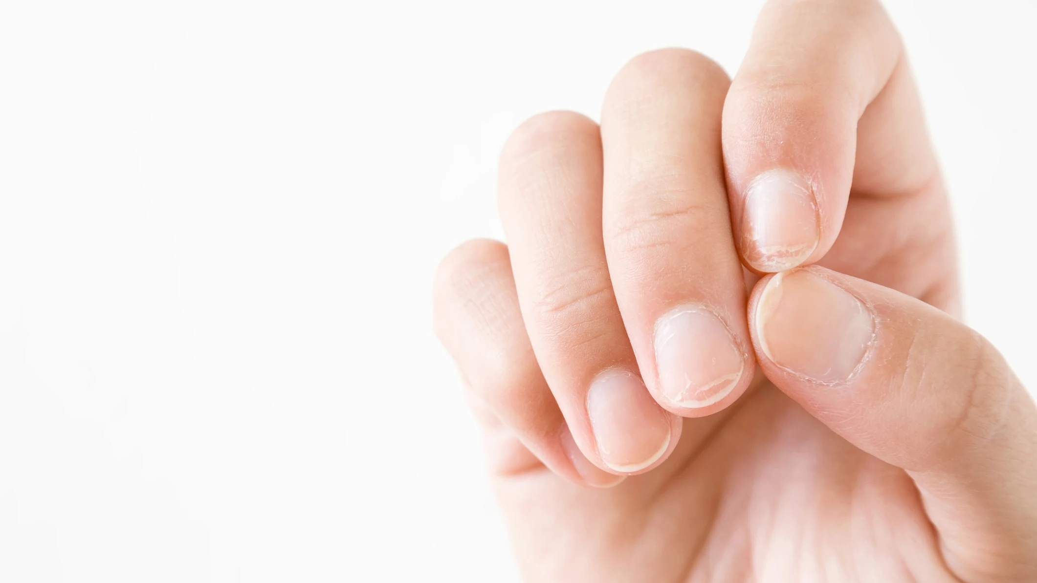 Uñas dañadas y amarillentas Uñas dañadas y amarillentas