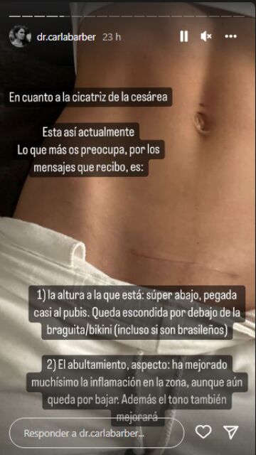 Carla Barber enseña la cicatriz de la cesárea