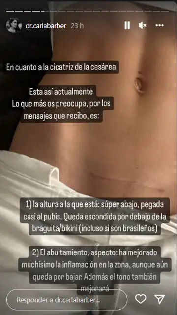 Carla Barber enseña la cicatriz de la cesárea Carla Barber enseña la cicatriz de la cesárea