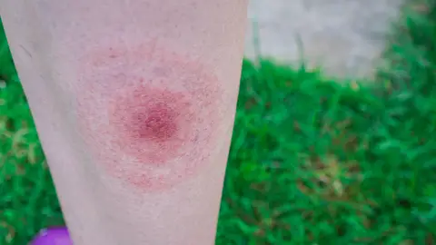 Sarpullido en forma de diana Sarpullido en forma de diana