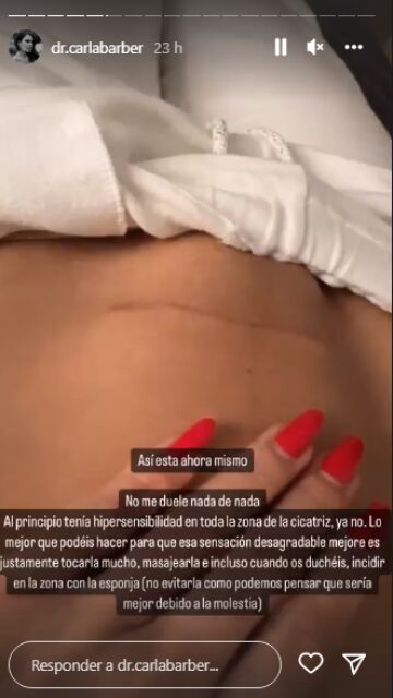 Carla Barber enseña la cicatriz tras dar a luz por cesárea