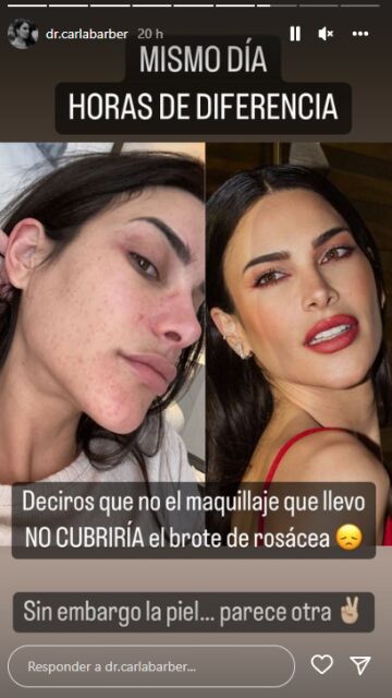 La cara de Carla Barber al sufrir un brote de rosácea
