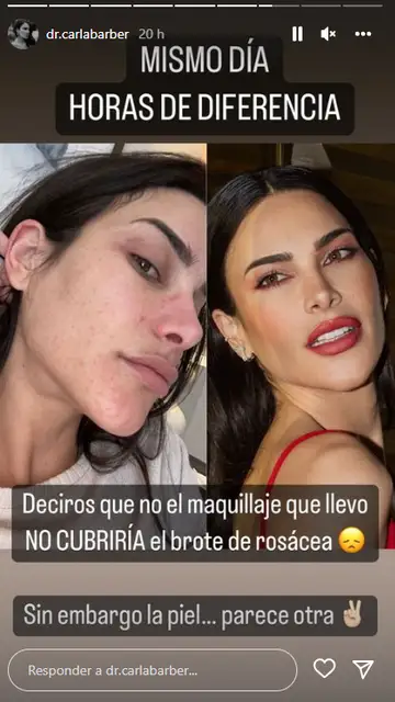 La cara de Carla Barber al sufrir un brote de rosácea La cara de Carla Barber al sufrir un brote de rosácea