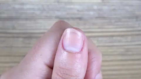 Estrías de las uñas Estrías de las uñas