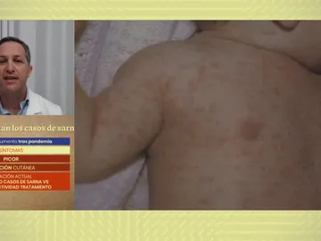 Aumentan los casos de sarna. Aumentan los casos de sarna.