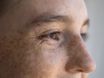 Manchas solares en rostro Manchas solares en rostro