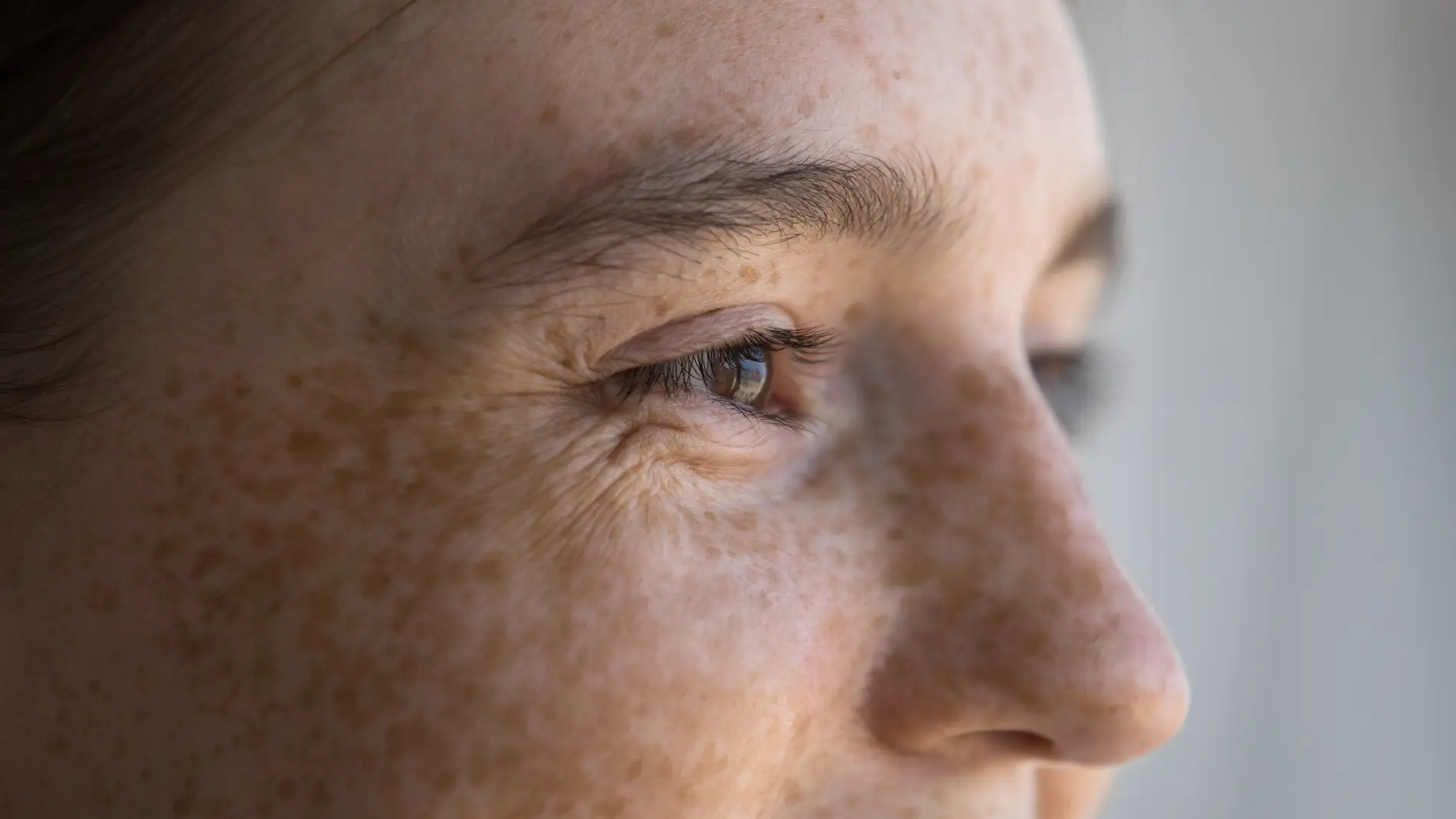 Manchas solares en rostro
