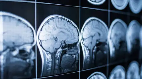 Neuroimágenes de cerebros humanos Neuroimágenes de cerebros humanos