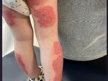 Sufre psoriasis desde antes de cumplir un año