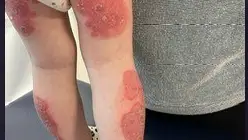 Sufre psoriasis desde antes de cumplir un a&ntilde;o