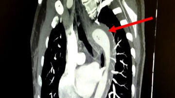 Muestra de un hematoma intramural de la aorta torácica