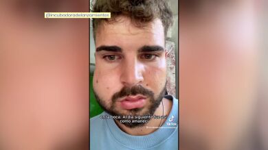 Un turista español de vacaciones en México va al dentista y acaba con la cara deformada