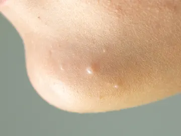 Zona del tobillo con molusco contagioso. Zona del tobillo con molusco contagioso.
