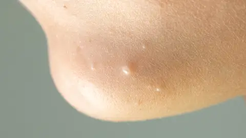 Zona del tobillo con molusco contagioso. Zona del tobillo con molusco contagioso.